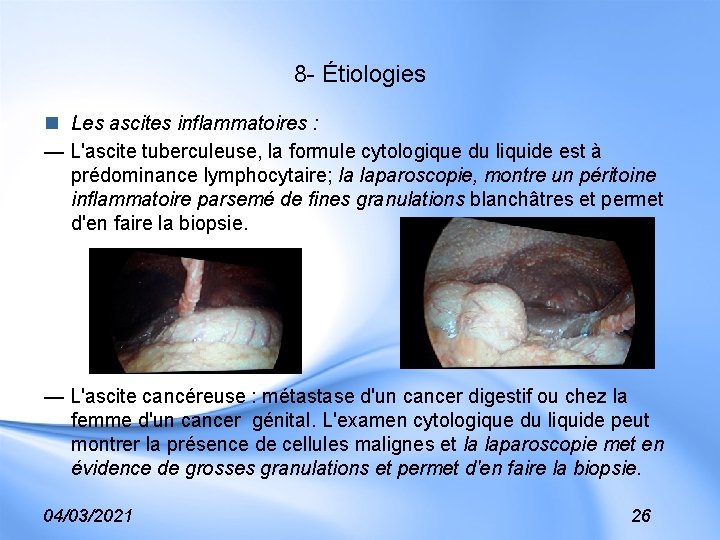 8 - Étiologies n Les ascites inflammatoires : — L'ascite tuberculeuse, la formule cytologique