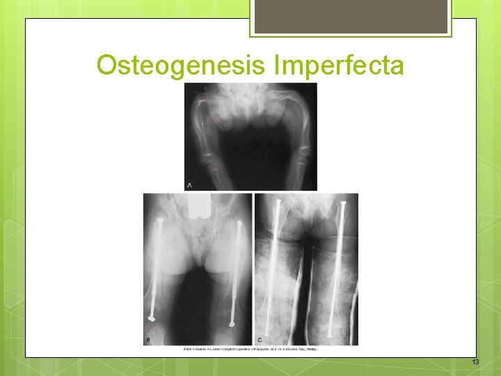 Osteogenesis Imperfecta 13 