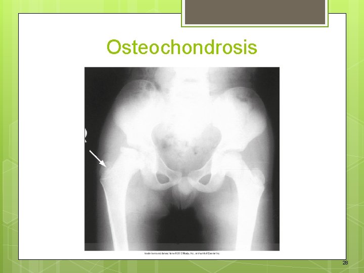 Osteochondrosis 28 