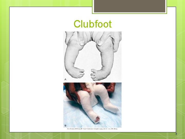 Clubfoot 3 