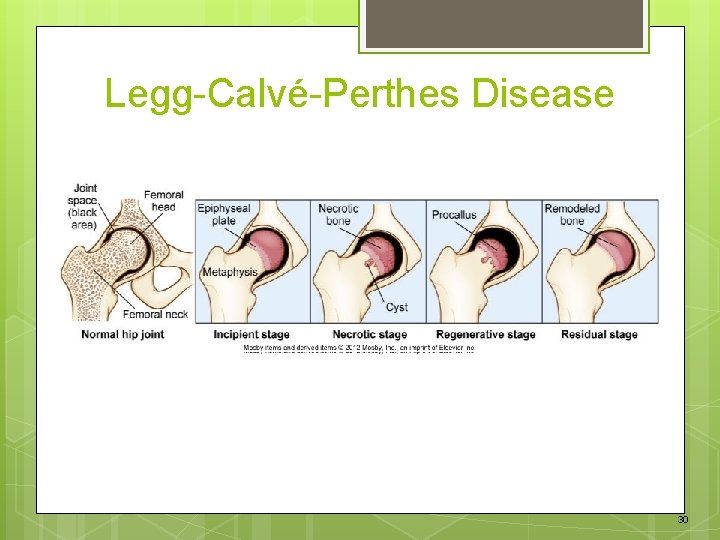 Legg-Calvé-Perthes Disease 30 