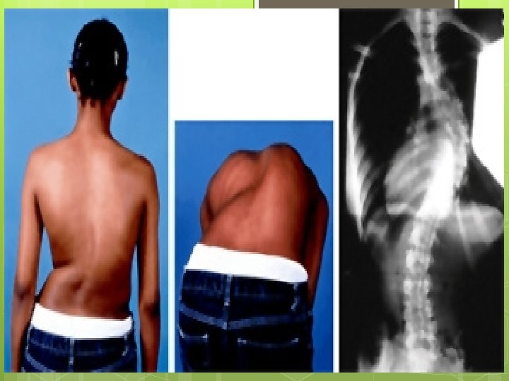 Scoliosis 33 