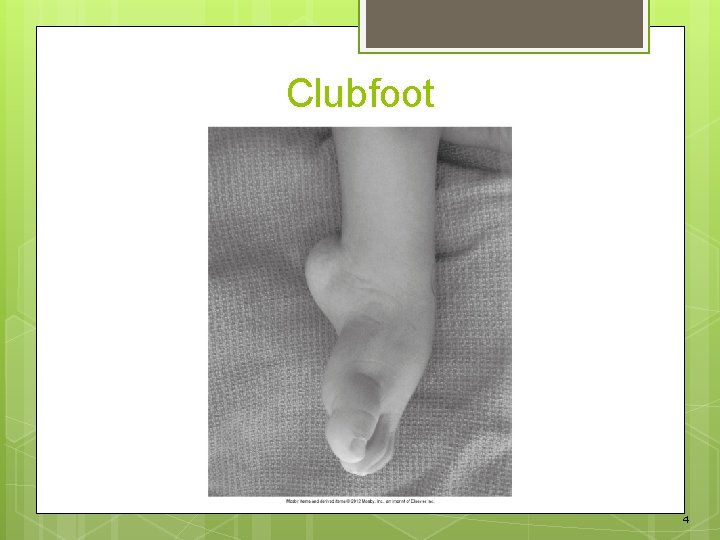 Clubfoot 4 