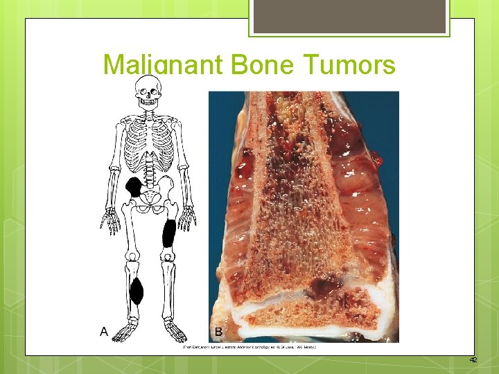 Malignant Bone Tumors 42 