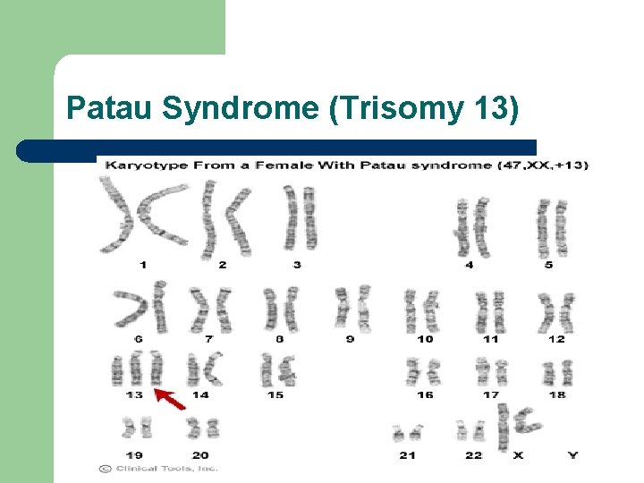 Patau Syndrome (Trisomy 13) 