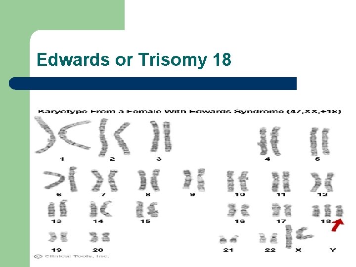 Edwards or Trisomy 18 