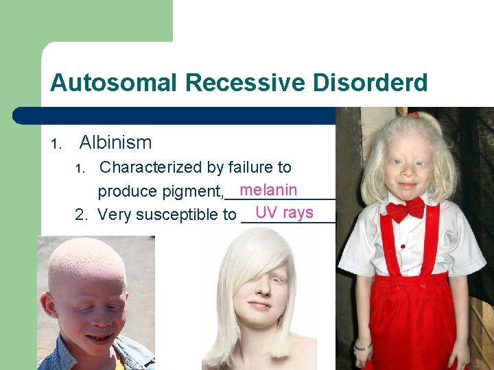 Autosomal Recessive Disorderd 1. Albinism Characterized by failure to melanin produce pigment, _______ UV