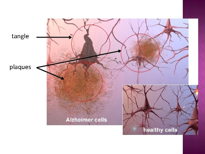 ALZHEIMERS DISEASE AND ITS TREATMENT WHAT IS ALZHEIMERS