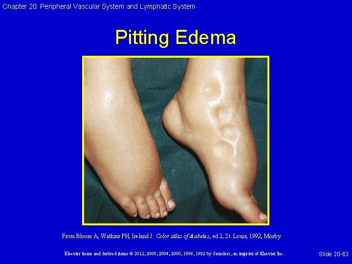 Chapter 20: Peripheral Vascular System and Lymphatic System Pitting Edema From Bloom A, Watkins