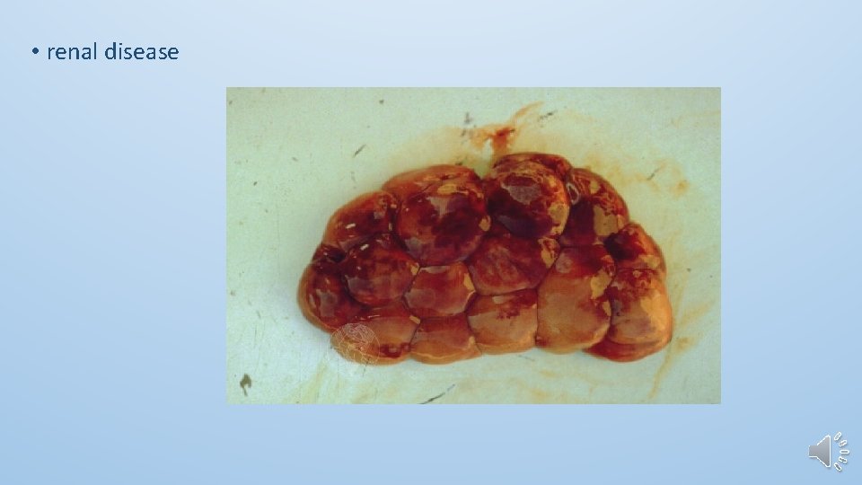  • renal disease 