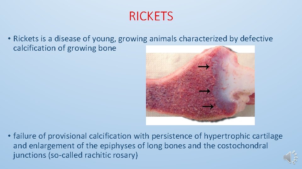 RICKETS • Rickets is a disease of young, growing animals characterized by defective calcification