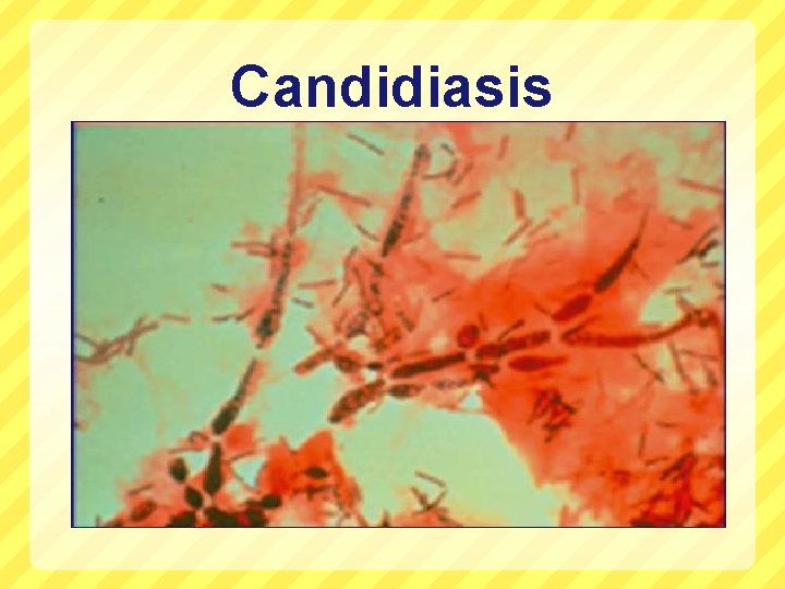 Laboratory Diagnosis of Vaginitis Termonology and Pathogenesis