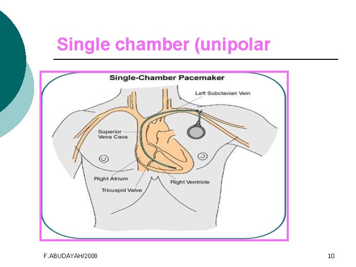 Single chamber (unipolar F. ABUDAYAH/2008 10 