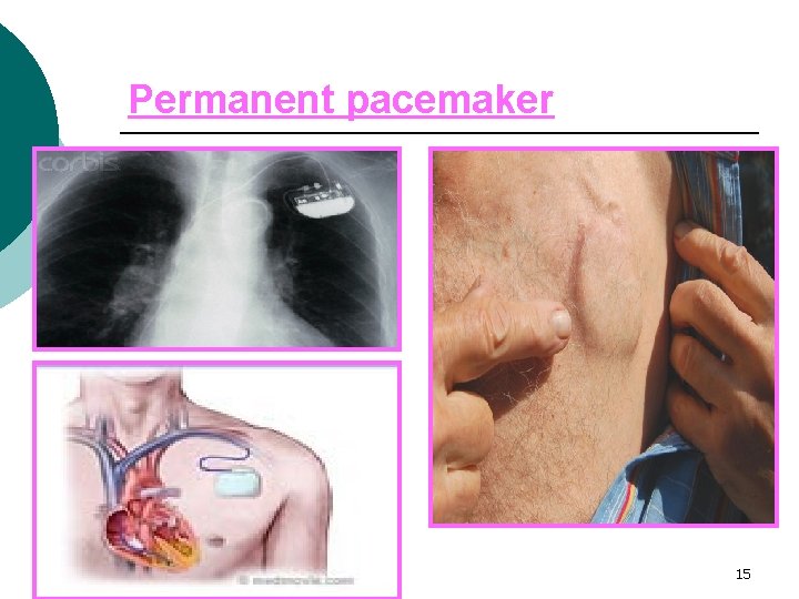 Permanent pacemaker F. ABUDAYAH/2008 15 