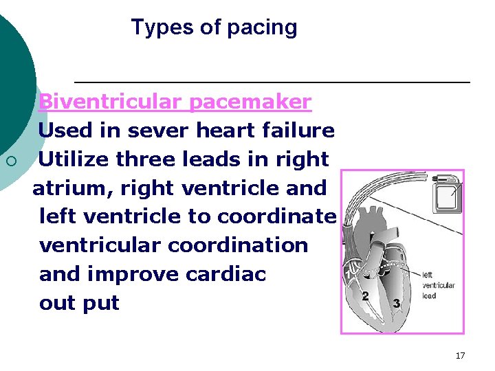 Types of pacing 3. ¡ ¡ Biventricular pacemaker Used in sever heart failure Utilize