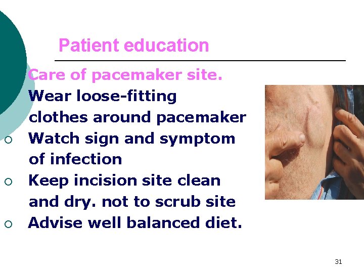 Patient education 6. ¡ ¡ Care of pacemaker site. Wear loose-fitting clothes around pacemaker