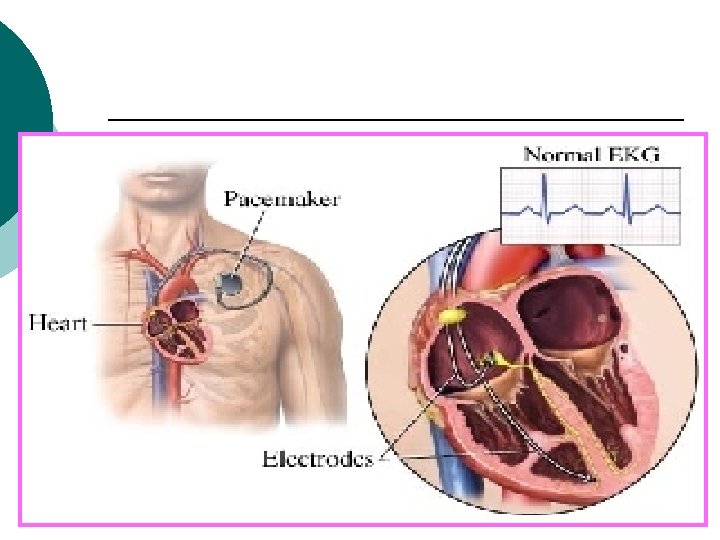 Dual-chamber (bipolar) pacemaker F. ABUDAYAH/2008 5 