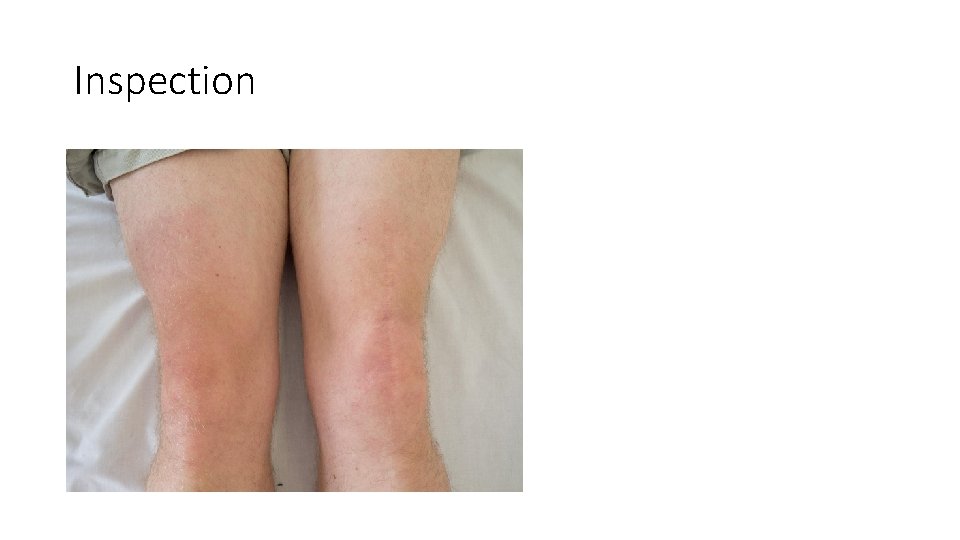 Stretch marks behind knees
