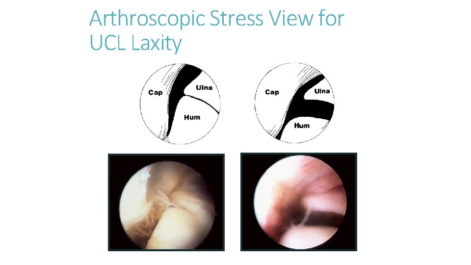 Arthroscopic Stress View for UCL Laxity Arthroscopic Stress View for UCL Laxity