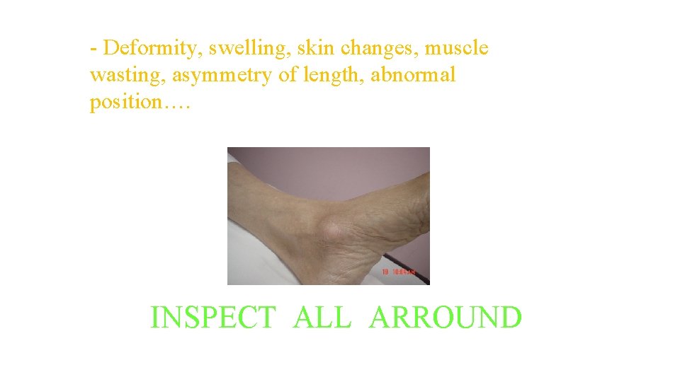 INSPECTION: - Deformity, swelling, skin changes, muscle wasting, asymmetry of length, abnormal position…. INSPECT INSPECTION: - Deformity, swelling, skin changes, muscle wasting, asymmetry of length, abnormal position…. INSPECT