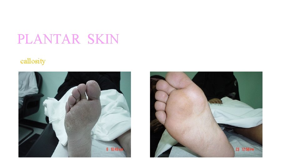 INSPECTION: PLANTAR SKIN callosity INSPECTION: PLANTAR SKIN callosity