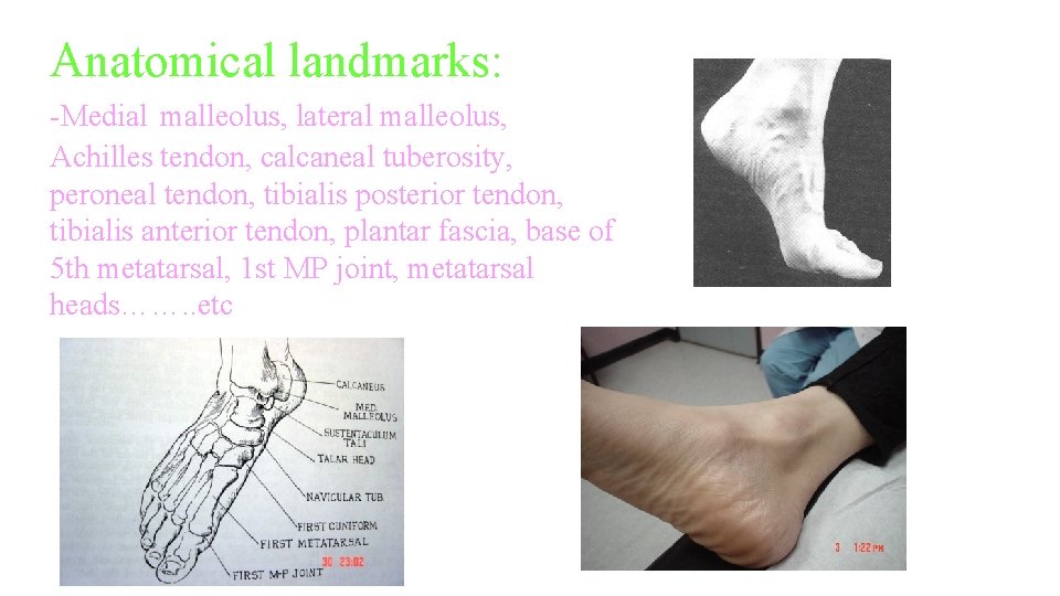 Anatomical landmarks: -Medial malleolus, lateral malleolus, Achilles tendon, calcaneal tuberosity, peroneal tendon, tibialis posterior Anatomical landmarks: -Medial malleolus, lateral malleolus, Achilles tendon, calcaneal tuberosity, peroneal tendon, tibialis posterior