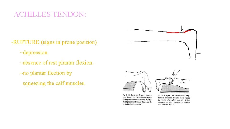 ACHILLES TENDON: -RUPTURE: (signs in prone position) ~depression. ~absence of rest plantar flexion. ~no ACHILLES TENDON: -RUPTURE: (signs in prone position) ~depression. ~absence of rest plantar flexion. ~no