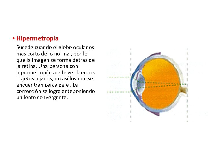  • Hipermetropía Sucede cuando el globo ocular es mas corto de lo normal,