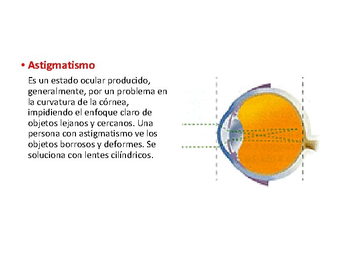 • Astigmatismo Es un estado ocular producido, generalmente, por un problema en la • Astigmatismo Es un estado ocular producido, generalmente, por un problema en la