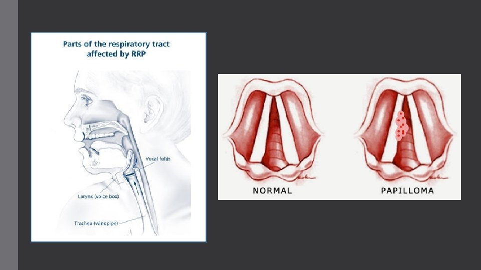 Laryngeal papillomas symptoms - Laryngeal papillomatosis surgeon