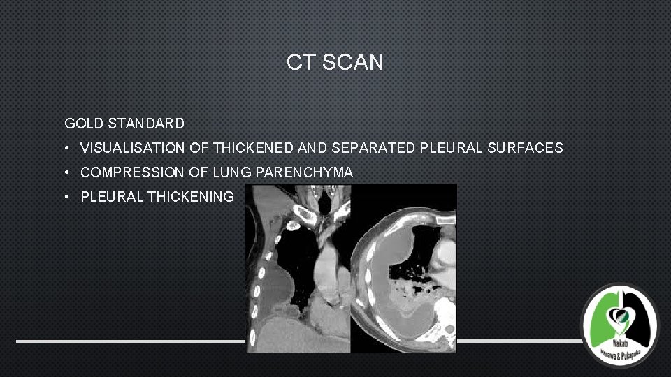 CT SCAN GOLD STANDARD • VISUALISATION OF THICKENED AND SEPARATED PLEURAL SURFACES • COMPRESSION