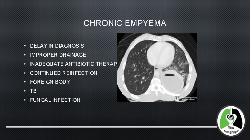 CHRONIC EMPYEMA • DELAY IN DIAGNOSIS • IMPROPER DRAINAGE • INADEQUATE ANTIBIOTIC THERAPY •