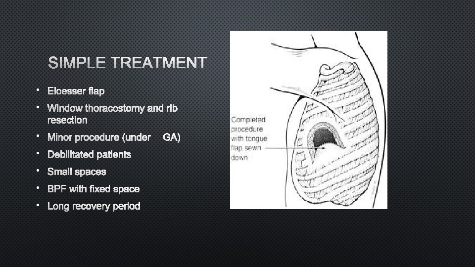 SIMPLE TREATMENT • ELOESSER FLAP • WINDOW THORACOSTOMY AND RIB RESECTION • MINOR PROCEDURE