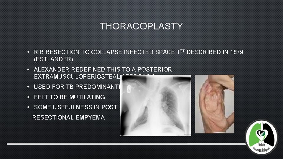 THORACOPLASTY • RIB RESECTION TO COLLAPSE INFECTED SPACE 1 ST DESCRIBED IN 1879 (ESTLANDER)