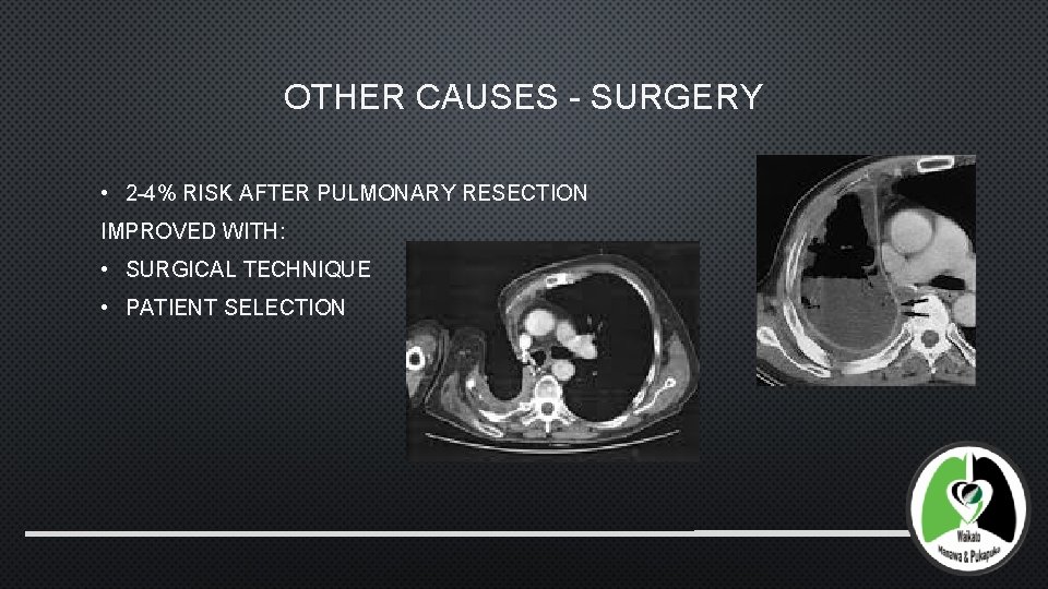 OTHER CAUSES - SURGERY • 2 -4% RISK AFTER PULMONARY RESECTION IMPROVED WITH: •