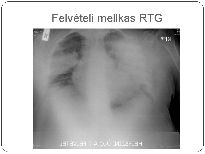 Felvételi mellkas RTG 