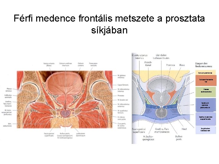 Férfi medence frontális metszete a prosztata síkjában Cavum peritonei Subperitonealis tér Fossa ischioanalis Spatium