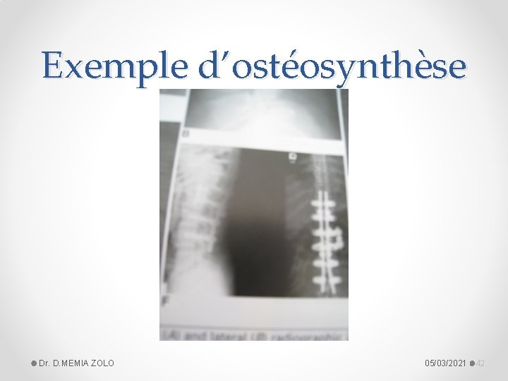 Exemple d’ostéosynthèse Dr. D. MEMIA ZOLO 05/03/2021 42 