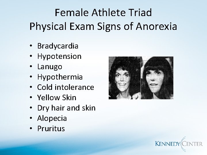 Female Athlete Triad Physical Exam Signs of Anorexia • • • Bradycardia Hypotension Lanugo