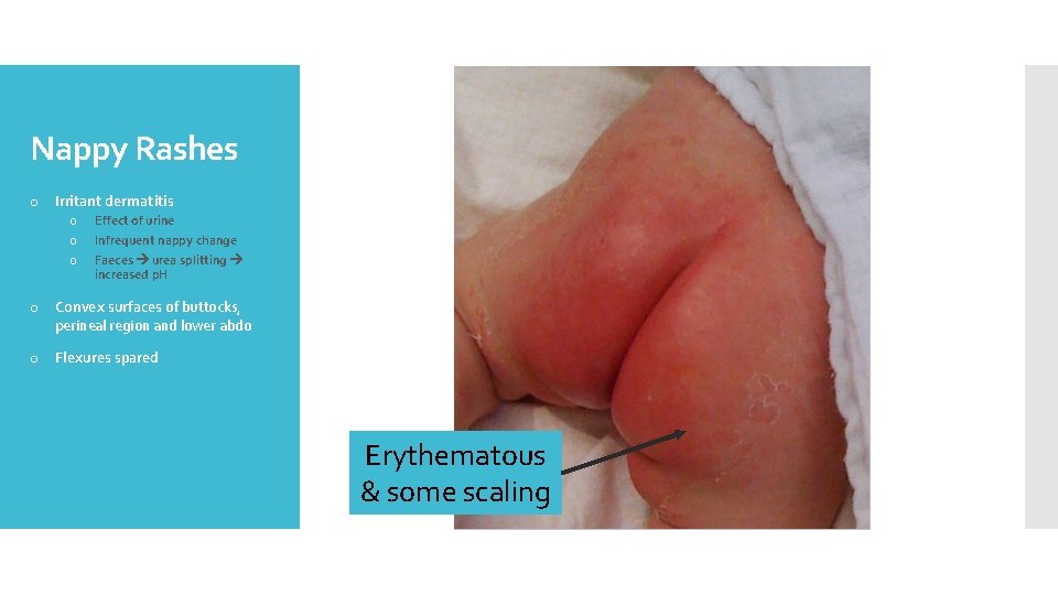 Nappy Rashes o Irritant dermatitis o o o Effect of urine Infrequent nappy change