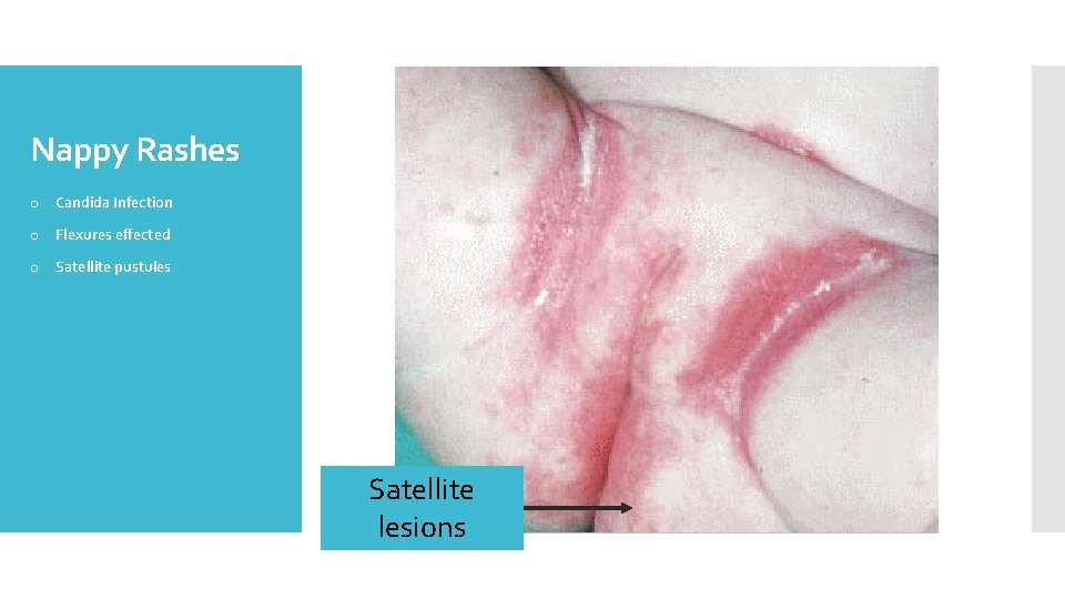 Nappy Rashes o Candida Infection o Flexures effected o Satellite pustules Satellite lesions 