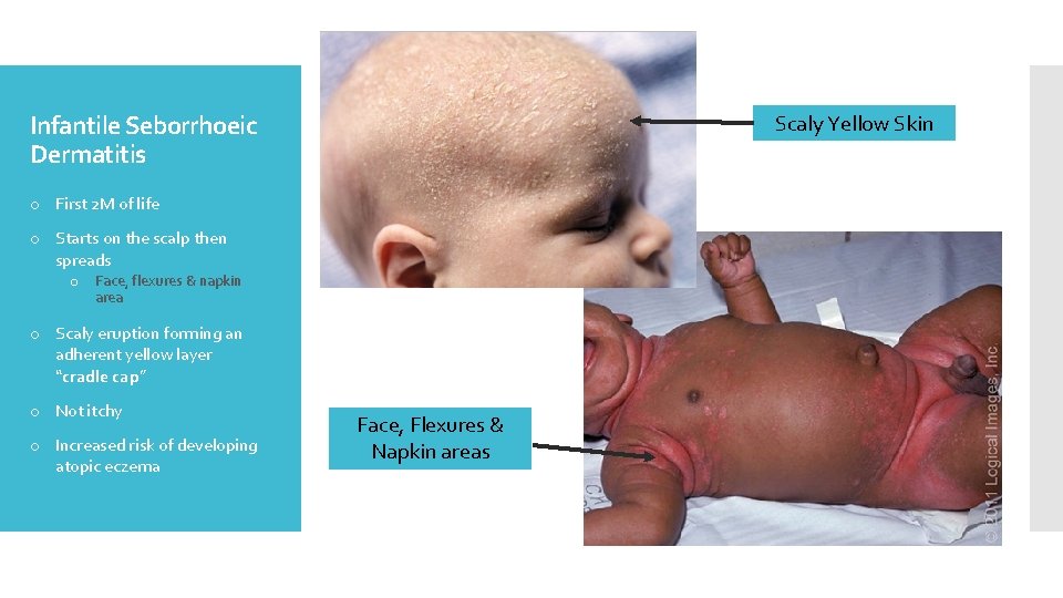 Infantile Seborrhoeic Dermatitis Scaly Yellow Skin o First 2 M of life o Starts