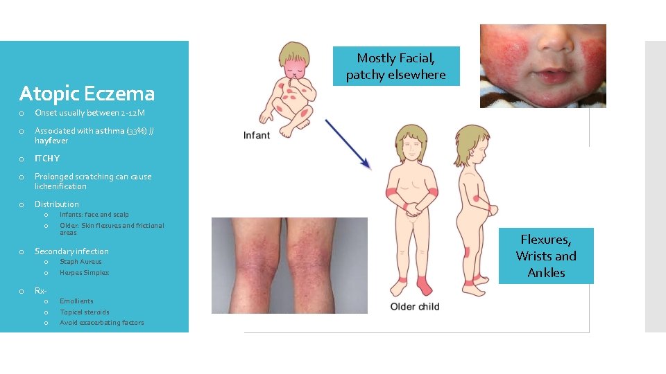 Atopic Eczema o Onset usually between 2 -12 M o Associated with asthma (33%)