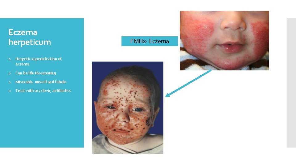 Eczema herpeticum o Herpetic superinfection of eczema o Can be life threatening o Miserable,