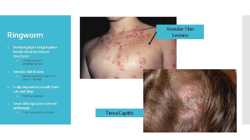 Annular Skin Lesions Ringworm o Dermatophyte fungi hyphae invade dead keratinous structures o Horny