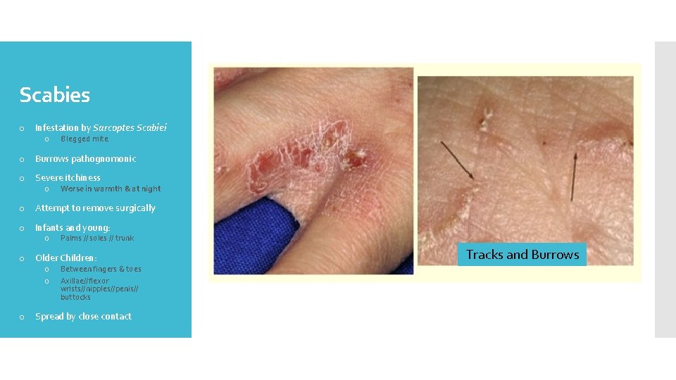 Scabies o Infestation by Sarcoptes Scabiei o 8 legged mite o Burrows pathognomonic o