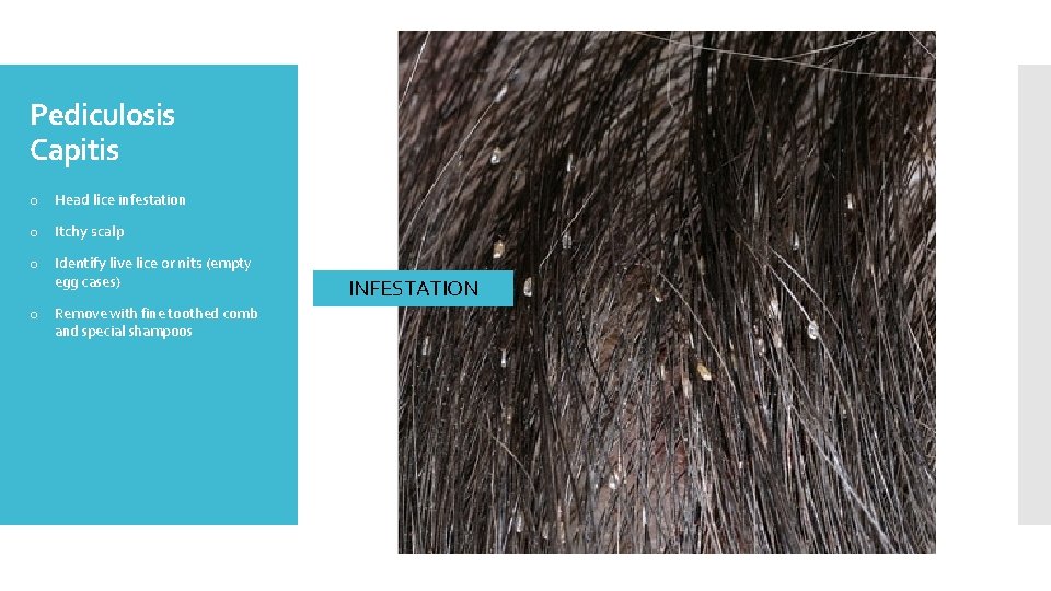 Pediculosis Capitis o Head lice infestation o Itchy scalp o Identify live lice or