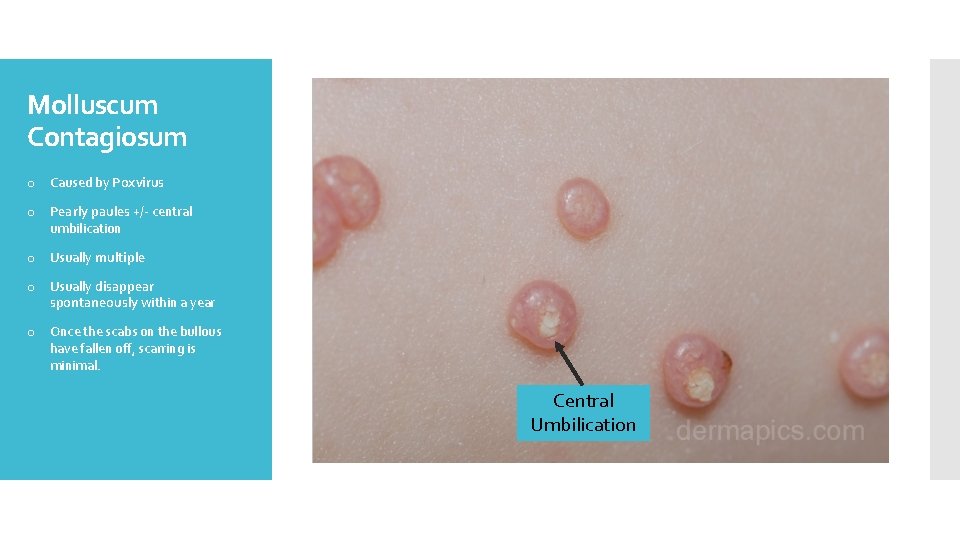 Molluscum Contagiosum o Caused by Poxvirus o Pearly paules +/- central umbilication o Usually