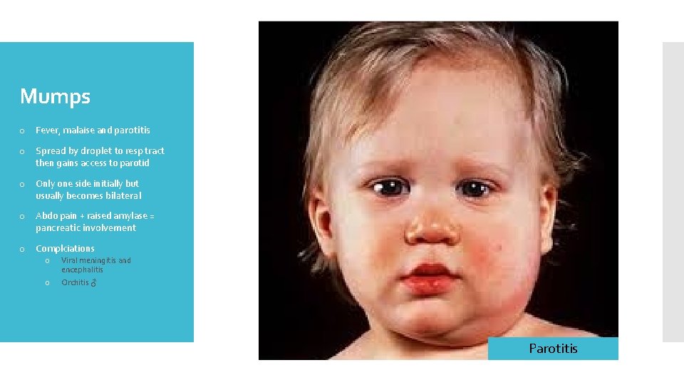 Mumps o Fever, malaise and parotitis o Spread by droplet to resp tract then