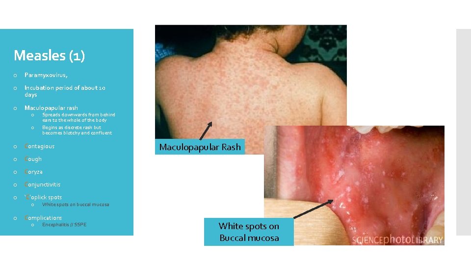 Measles (1) o Paramyxovirus, o Incubation period of about 10 days o Maculopapular rash